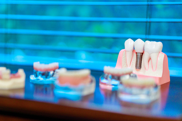 Dental implant model at Wheaton Oral Surgery in Naperville, IL