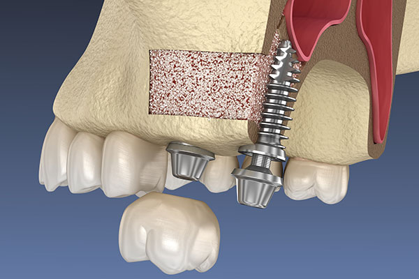 illustration of a bone graft for ridge preservation