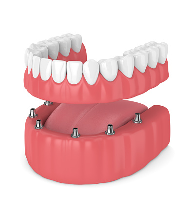 Diagram of full arch dental implant