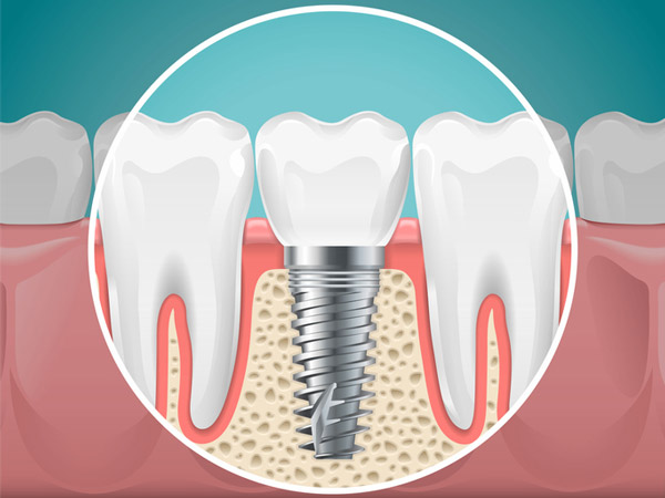 Diagram of a tooth replaced with a dental implant at Wheaton Oral Surgery in Naperville, IL