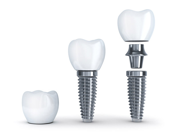 Diagram of dental implant with post at Wheaton Oral Surgery in Naperville IL Diagram of dental implant with post at Wheaton Oral Surgery in Naperville IL