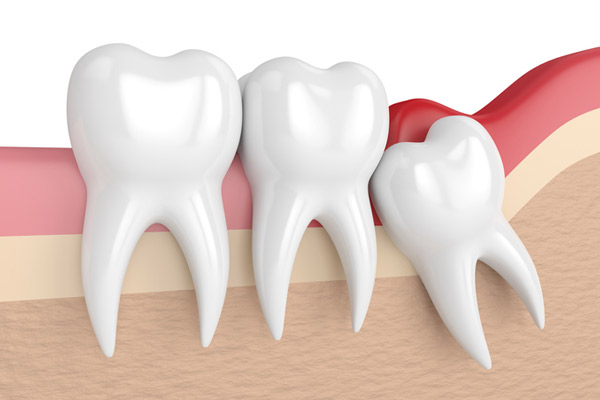Illustration of an impacted wisdom tooth before removal at Wheaton Oral Surgery in Naperville, IL